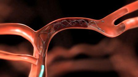 Stent Norfolk and Norwich University Hospitals NHS Foundation Trust » Stent